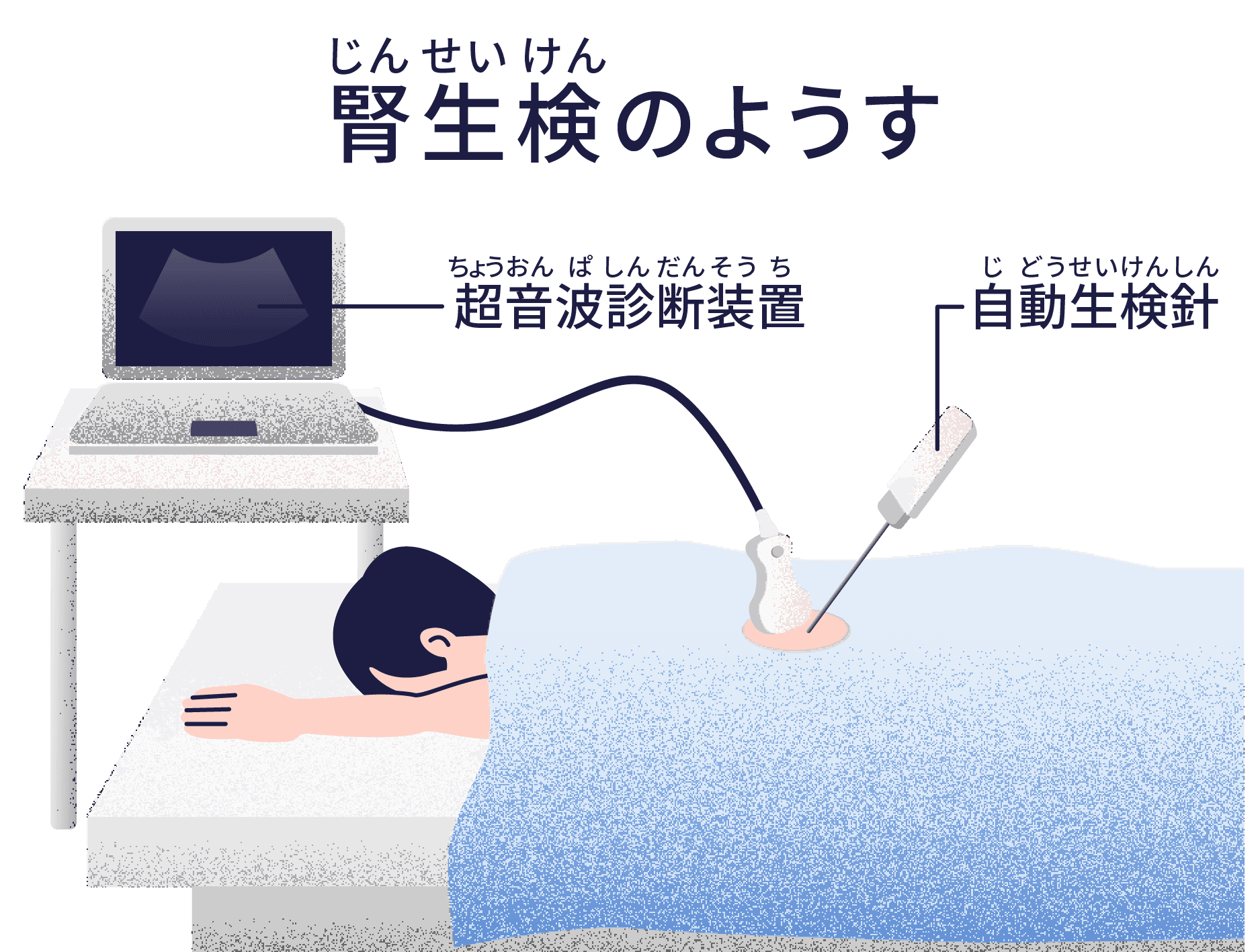 腎生検のようす