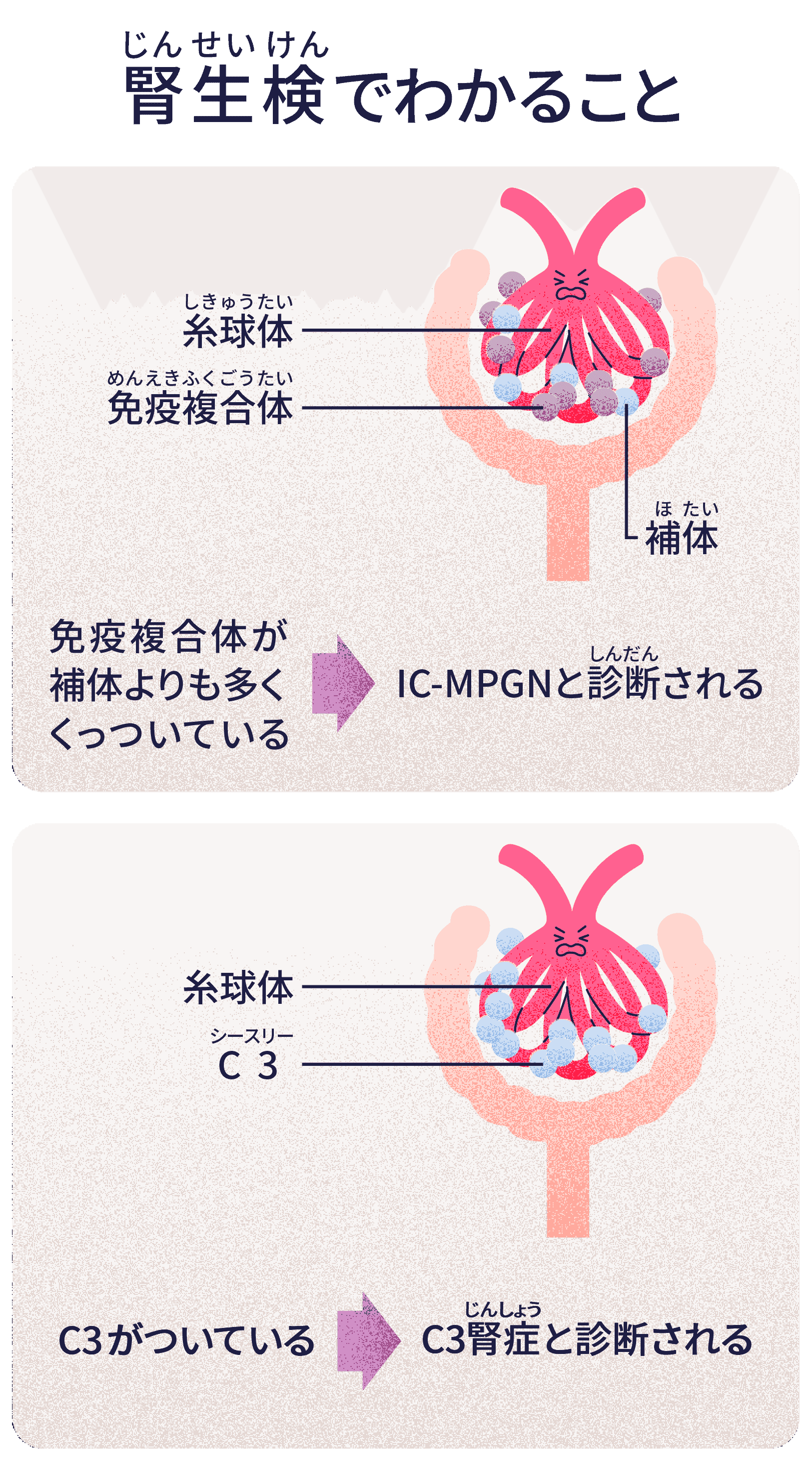 腎生検でわかること